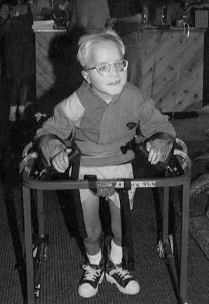 Patau Syndrome Patau (11).jpg